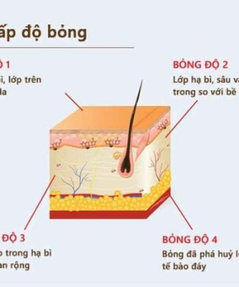 3 cấp độ bỏng khi bé bị bỏng sữa. (Ảnh: Nguồn Internet)