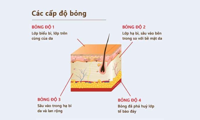 3 cấp độ bỏng khi bé bị bỏng sữa. (Ảnh: Nguồn Internet)