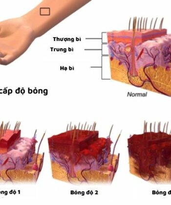 Các cấp độ bỏng. (Ảnh: Nguồn Internet)