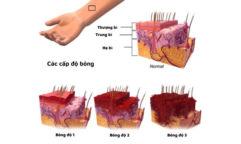 Các cấp độ bỏng. (Ảnh: Nguồn Internet)