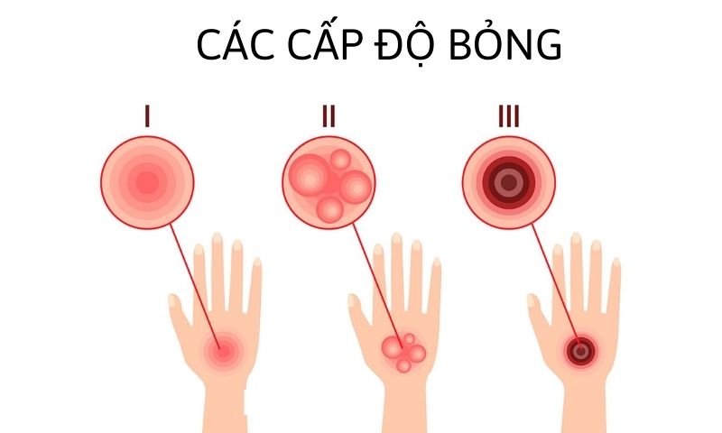 Các cấp độ bỏng ở trẻ. (Ảnh: Nguồn Internet)