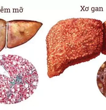 Phân biệt gan nhiễm mỡ và xơ gan (Nguồn: Internet)