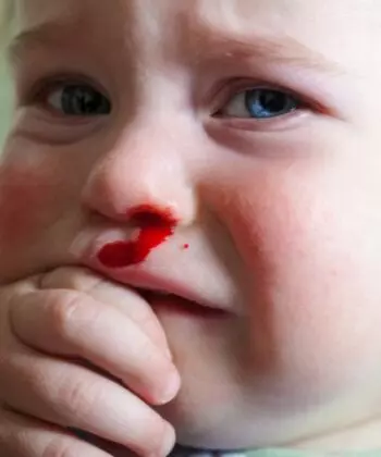 Trẻ 1 tuổi bị chảy máu cam do đâu. (Ảnh: Nguồn Internet)