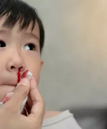 Các nguyên nhân khiến trẻ 3 tuổi bị chảy máu cam. (Ảnh: Nguồn Internet)