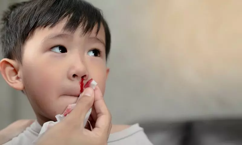 Chảy máu mũi trước thường gặp ở trẻ. (Ảnh: Nguồn Internet)