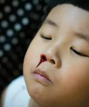 Trẻ 6 tuổi bị chảy máu cam. (Ảnh: Nguồn Internet)
