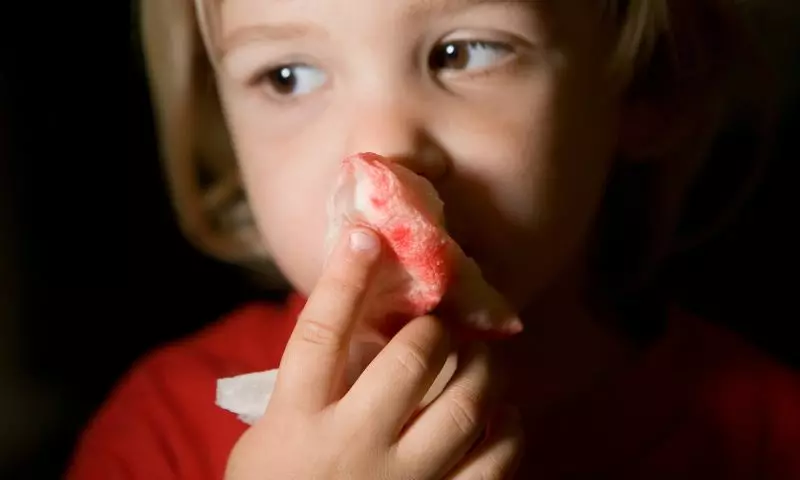 Trẻ bị ngã chảy máu mũi trong quá trình chơi đùa. (Ảnh: Nguồn Internet)