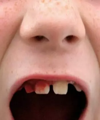 Trẻ bị ngã mẻ răng vĩnh viễn