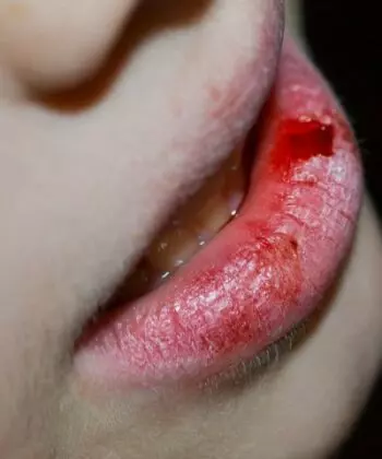 Cầm máu cho trẻ khi bị ngã dập môi. (Ảnh: Nguồn Internet)