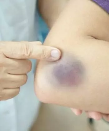 Trẻ bị ngã sưng tay gặp chấn thương sưng tấy, bầm tím tay do va đập (Nguồn: Sưu tầm Internet)