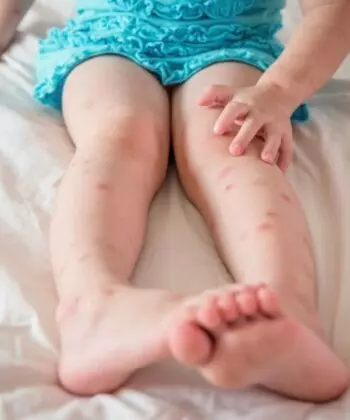 Trẻ bị côn trùng cắn thường xuất hiện những vết mẩn đỏ trên da (Ảnh: Sưu tầm internet)